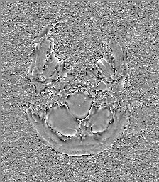 Central neurocytoma (Radiopaedia 84497-99872 Axial 6).jpg