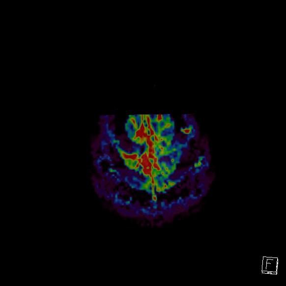 Central neurocytoma (Radiopaedia 84497-99872 Axial Perfusion 12).jpg