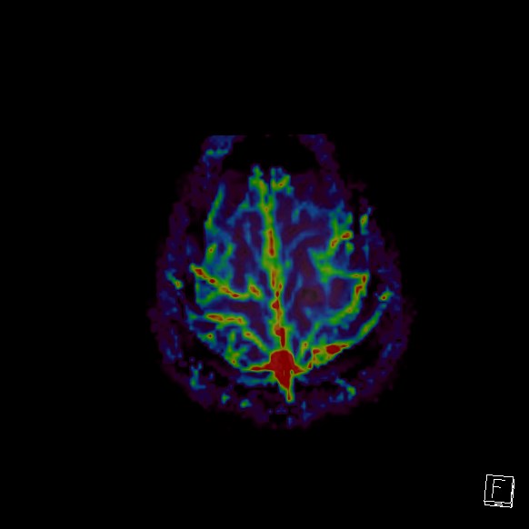 Central neurocytoma (Radiopaedia 84497-99872 Axial Perfusion 29).jpg