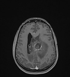 Central neurocytoma (Radiopaedia 84497-99872 Axial T1 C+ 104).jpg