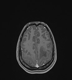 Central neurocytoma (Radiopaedia 84497-99872 Axial T1 C+ 124).jpg