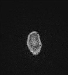 File:Central neurocytoma (Radiopaedia 84497-99872 Axial T1 C+ 154).jpg