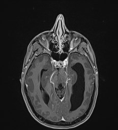Central neurocytoma (Radiopaedia 84497-99872 Axial T1 C+ 59).jpg