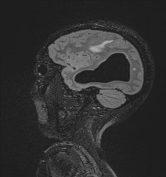File:Central neurocytoma (Radiopaedia 84497-99872 Sagittal Flair + Gd 116).jpg