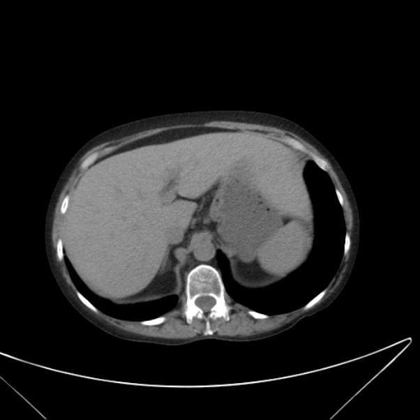Centrilobular pulmonary emphysema (Radiopaedia 24495-24789 Axial non-contrast 44).jpg