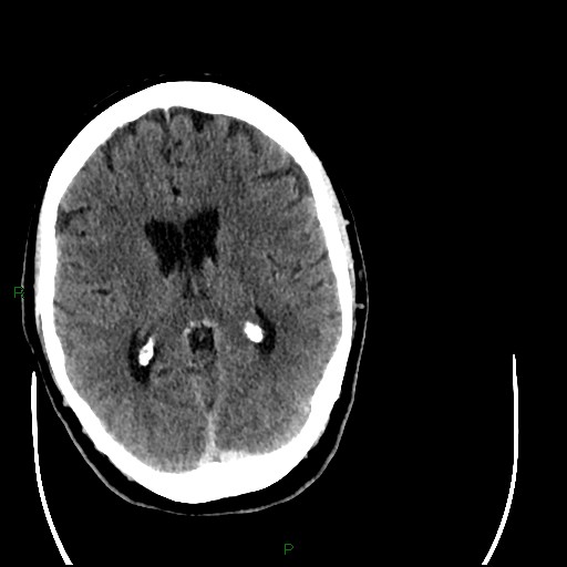 Cerebellar abscess (Radiopaedia 78135-90671 Axial C+ delayed 60).jpg