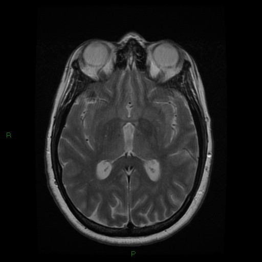File:Cerebellar abscess (Radiopaedia 78135-90678 Axial T2 16).jpg