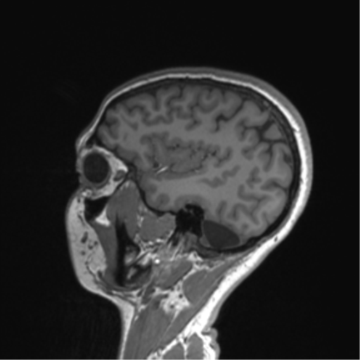 Cerebellar agenesis with hypoplastic pons (pontocerebellar hypoplasia) (Radiopaedia 57224-64138 Sagittal T1 50).png