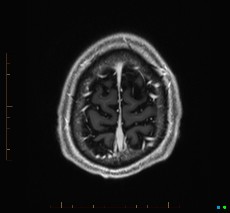Cerebellar gangliocytoma (Radiopaedia 65377-74422 Axial T1 C+ 132).jpg