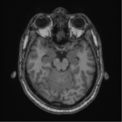 File:Cerebellar hemangioblastomas and pituitary adenoma (Radiopaedia 85490-101176 Axial T1 28).png