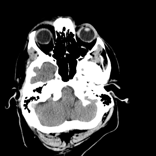 File:Cerebellar infarct due to vertebral artery dissection with posterior fossa decompression (Radiopaedia 82779-97029 Axial non-contrast 4).png
