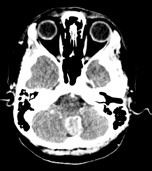 Cerebellar metastases - colorectal adenocarcinoma (Radiopaedia 40947-43652 Axial C+ 9).png