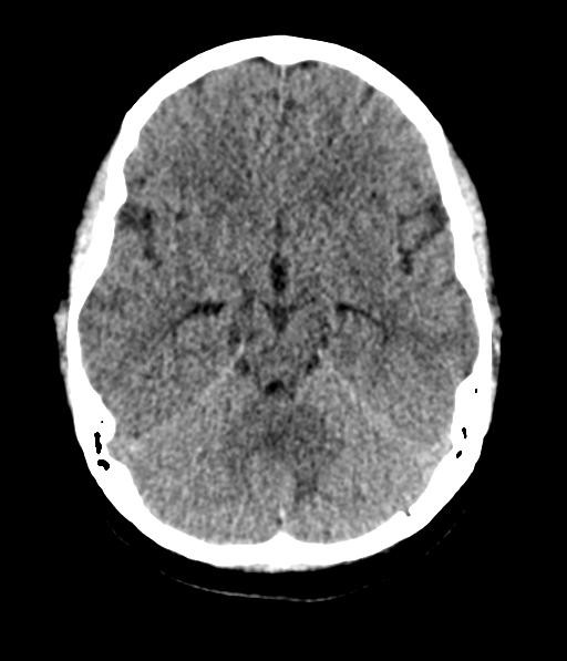 Cerebellar metastases - colorectal adenocarcinoma (Radiopaedia 40947-43652 Axial non-contrast 23).png