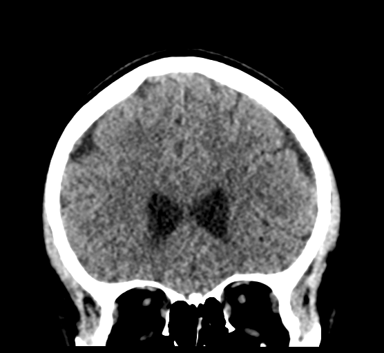 Cerebellar metastases - colorectal adenocarcinoma (Radiopaedia 40947-43652 Coronal non-contrast 32).png