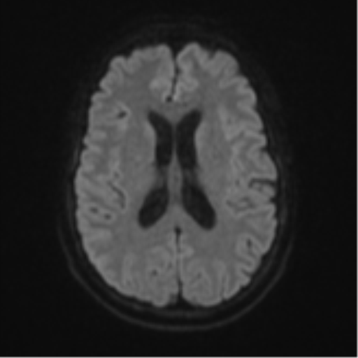 Cerebellar metastasis (Radiopaedia 51137-56765 Axial DWI 45).png