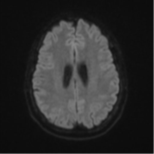 Cerebellar metastasis (Radiopaedia 51137-56765 Axial DWI 47).png