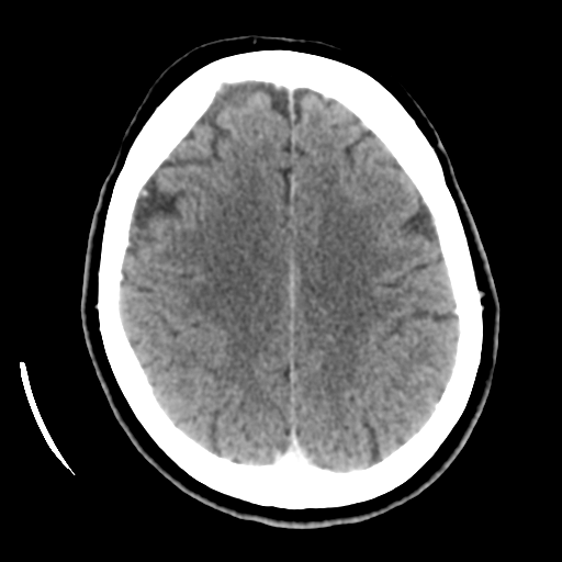 Cerebellar metastasis (cystic appearance) (Radiopaedia 41395-44258 B 36).png
