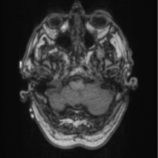 Cerebellar metastasis from lung adenocarcinoma (Radiopaedia 86690-102829 Axial T1 16).png