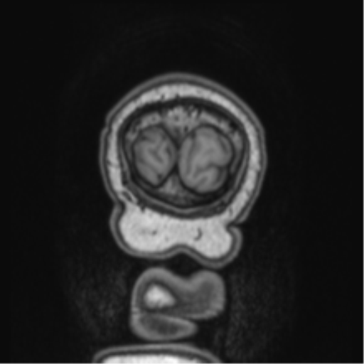 Cerebellar metastasis from lung adenocarcinoma (Radiopaedia 86690-102829 Coronal T1 5).png