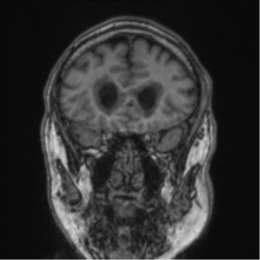 Cerebellar metastasis from lung adenocarcinoma (Radiopaedia 86690-102829 Coronal T1 73).png