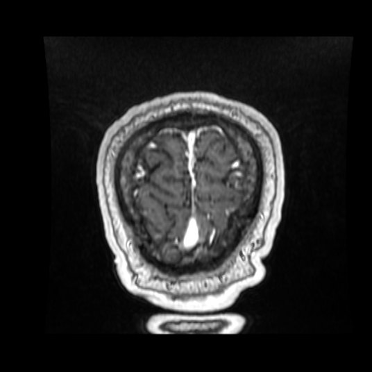 Cerebellar metastasis of pulmonary adenocarcinoma, cavernous venous malformation, and developmental venous anomaly (Radiopaedia 85827-101661 Coronal T1 C+ 16).jpg