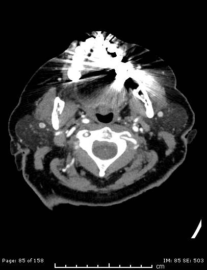 Cerebellar strokes due to intracranial giant cell arteritis (Radiopaedia 68799-78510 CT angiogram 85).jpg