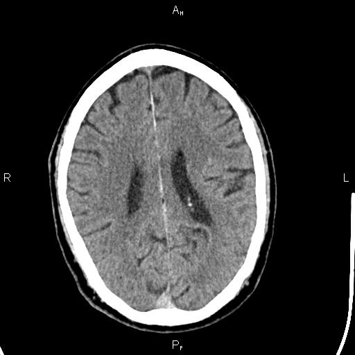 File:Cerebellopontine angle arachnoid cyst (Radiopaedia 85149-100704 Axial With contrast 32).jpg