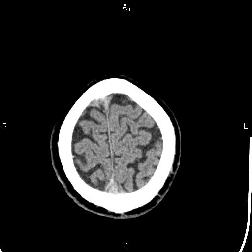 Cerebellopontine angle arachnoid cyst (Radiopaedia 85149-100704 Axial With contrast 47).jpg