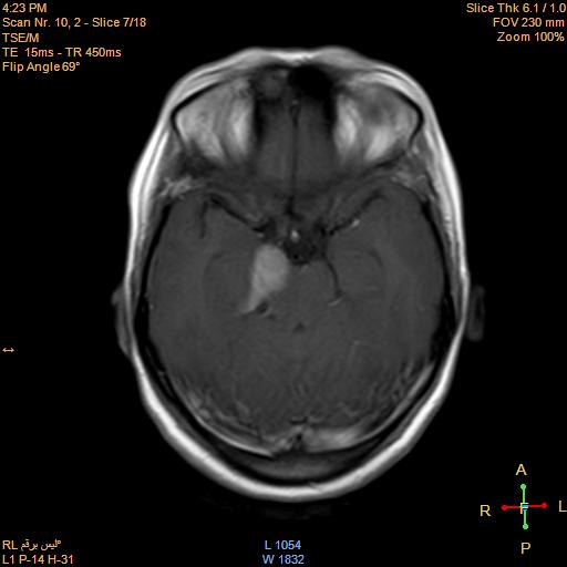 File:Cerebellopontine angle meningioma (Radiopaedia 22488-22525 Axial T1 C+ 6).jpg