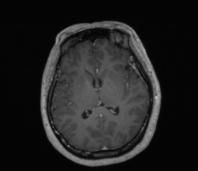 Cerebellopontine angle meningioma (Radiopaedia 35181-36715 Axial T1 C+ 27).jpg
