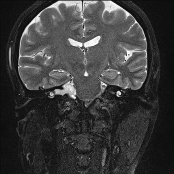 File:Cerebellopontine angle meningioma (Radiopaedia 53561-59591 Coronal T2 10).jpg