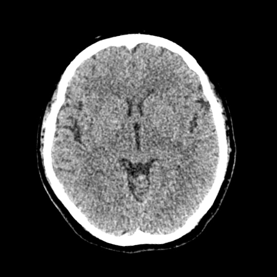 Cerebellopontine angle meningioma (Radiopaedia 53561-59592 Axial non-contrast 32).jpg