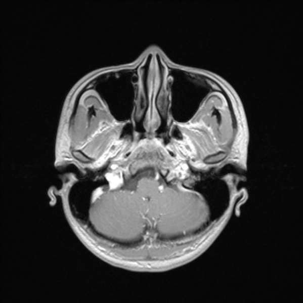 Cerebral abscess (Radiopaedia 24212-24478 Axial T1 C+ 15).jpg