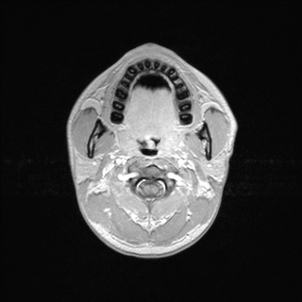 Cerebral abscess (Radiopaedia 24212-24478 Axial T1 C+ 2).jpg