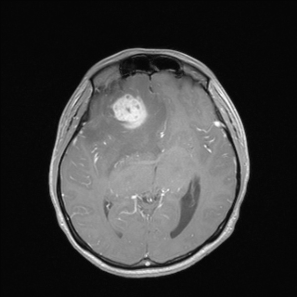 Cerebral abscess (Radiopaedia 24212-24478 Axial T1 C+ 30).jpg