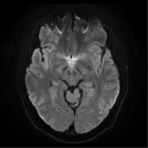 File:Cerebral abscess (Radiopaedia 57774-64740 Axial DWI 12).png