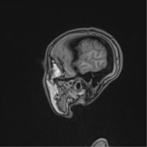 Cerebral abscess (Radiopaedia 60342-68009 Sagittal T1 50).png