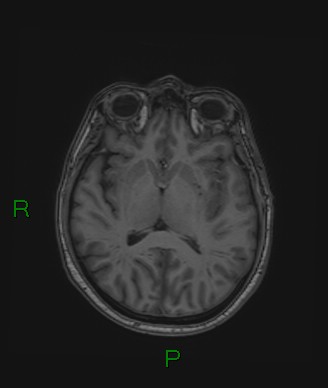 Cerebral abscess and subdural empyema (Radiopaedia 84436-99779 Axial T1 43).jpg