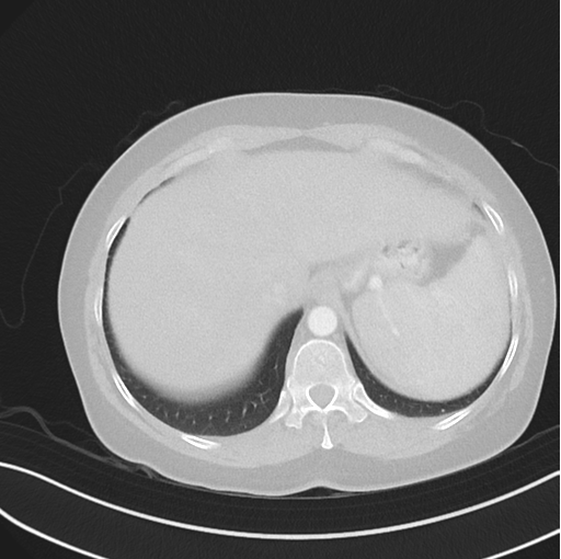 File:Cerebral abscess from pulmonary arteriovenous malformation (Radiopaedia 86275-102292 Axial lung window 51).png