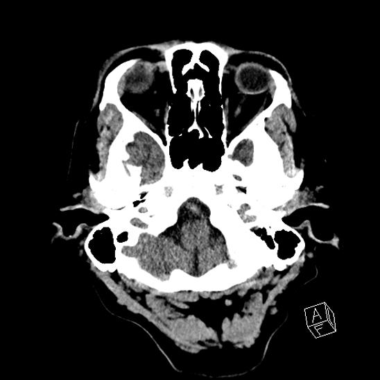 File:Cerebral abscess with ventriculitis (Radiopaedia 78965-91876 Axial non-contrast 10).jpg