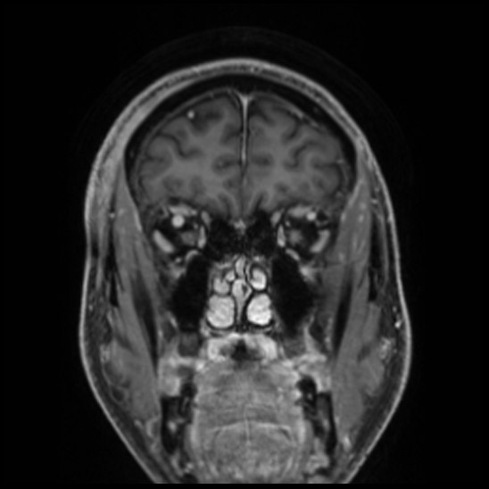 Cerebral abscess with ventriculitis (Radiopaedia 78965-91878 Coronal T1 C+ 16).jpg