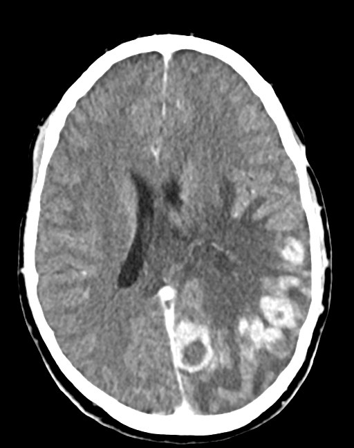 Cerebral abscesses (Radiopaedia 70458-80568 Axial Contrast 37).jpg