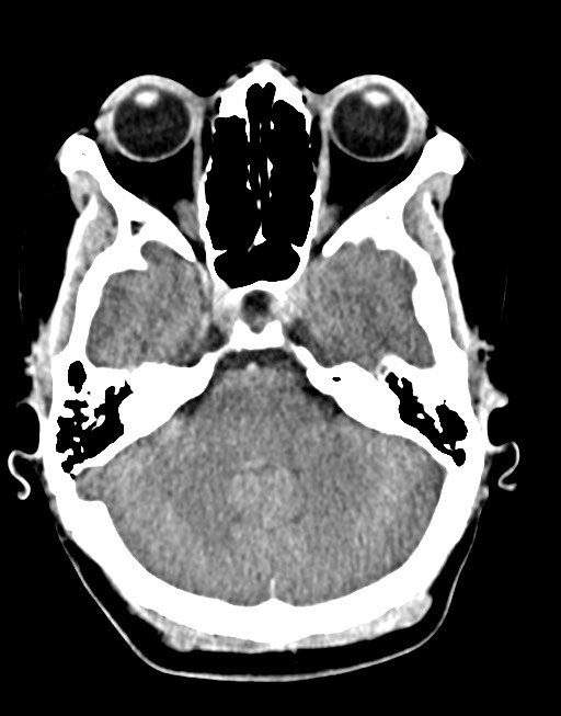 Cerebral abscesses (Radiopaedia 70458-80568 Axial non-contrast 19).jpg