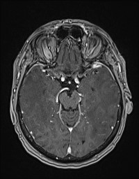 Cerebral amyloid angiopathy-related inflammation (Radiopaedia 58270-65377 Axial T1 C+ fat sat 53).jpg