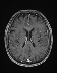 Cerebral amyloid angiopathy-related inflammation (Radiopaedia 58270-65377 Axial T1 C+ fat sat 88).jpg