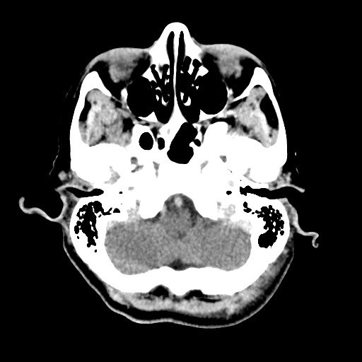 Cerebral amyloid angiopathy-related inflammation (Radiopaedia 74836-85848 Axial non-contrast 12).jpg