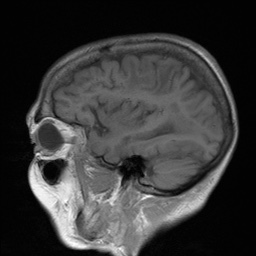 File:Cerebral amyloid angiopathy-related inflammation (Radiopaedia 74836-85849 Sagittal T1 25).jpg