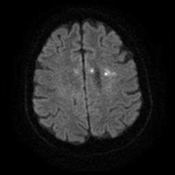 Cerebral amyloid angiopathy (Radiopaedia 28698-28978 Axial DWI 21).jpg