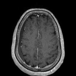 File:Cerebral amyloid angiopathy (Radiopaedia 29129-29518 Axial T1 C+ 110).jpg