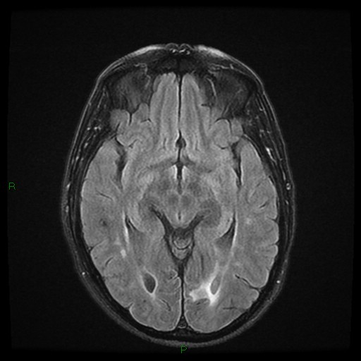 File:Cerebral amyloid angiopathy (Radiopaedia 77506-89664 Axial FLAIR 13).jpg